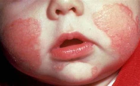 Eczema In Babies Tobb EtÜ Tıp Fakültesi Hastanesi