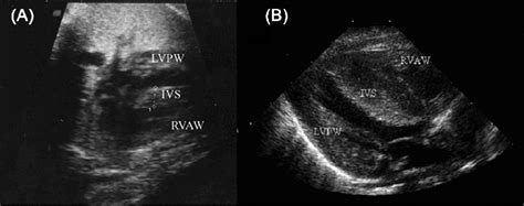 A Prenatal Bidimensional Echocardiographic Image Showing The