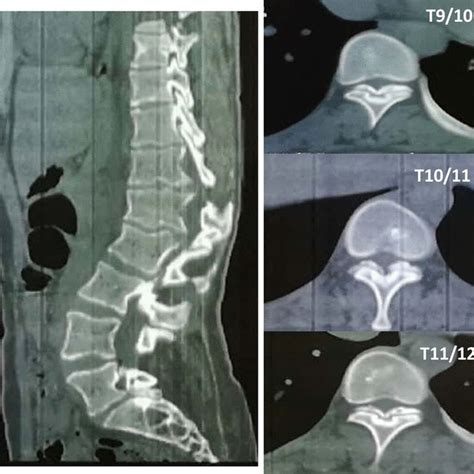 Sagittal And Axial Ct Scans Of The Thoracic Spine Demonstrating