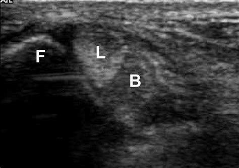 Dynamic Sonographic Evaluation Of Peroneal Tendon Subluxation Ajr