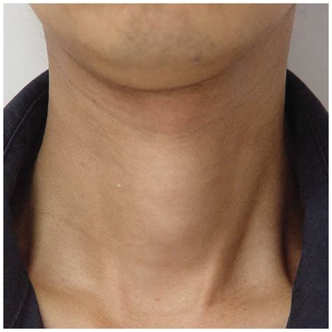 Human Gland In Neck