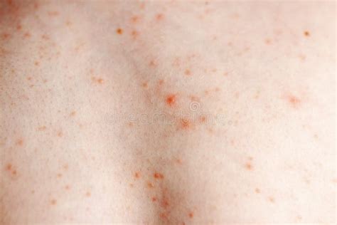 Close Up Image Of A Little Boy`s Body Suffering Severe Urticaria