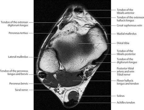 Bone contusions, osteonecrosis, marrow oedema syndromes, and stress > fractures) > synovial based disorders ( eg. Ankle and Foot | Radiology Key