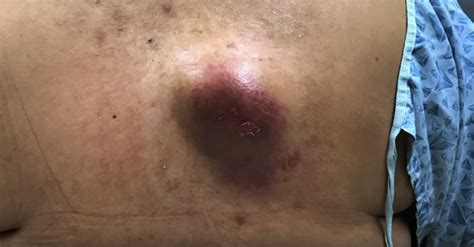 Inflamed Back Cyst Pop