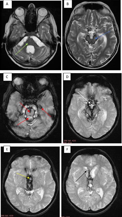 Typical Magnetic Resonance Imaging Mri Findings In Superficial