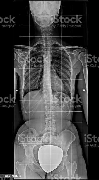 Xray Of Human Body From Chest To Pelvis Complete Spinal Scoliosis Front