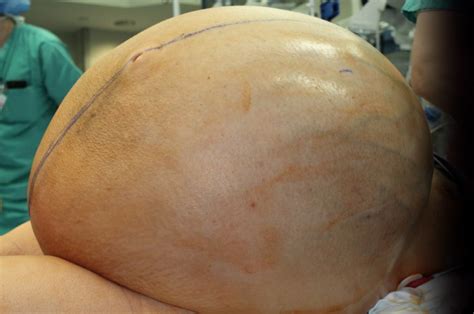 132 Pound Tumor Removed From Womans Abdomen