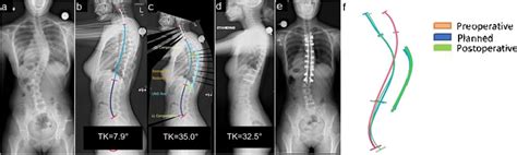Radiographs Of 17 Year Old Female With Adolescent Idiopathic Scoliosis Download Scientific