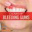 Bleeding Gums Characteristics Causes & Treatment