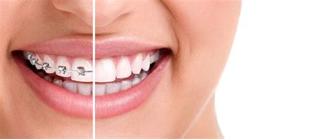 The Different Types Of Braces Dudley Smiles Orthodontics