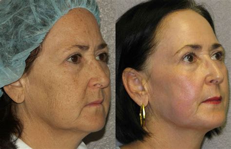 Laser Peel Laser Skin Resurfacing Peeling All About Cosmetology