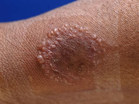 Mrsa As Related To Visa Vrsa Infections Pictures