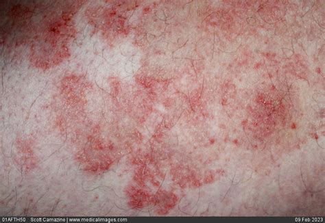 Stock Image Close Up Of Eczema Showing An Eczematous Skin Rash On The