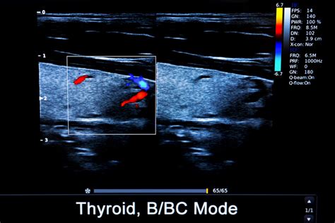 What Is A Thyroid Ultrasound Two Views