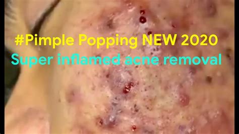 Pimple Popping 2020 Video 01 Blackheads Whiteheads And Inflamed