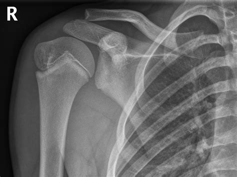 Normal Paediatric Shoulder 13 Year Old Male Wikiradiography