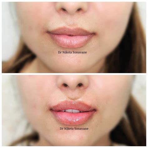 Lip Fillers In Mumbai Cost Before After Discount Dermal Fillers