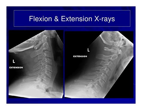 Ct Cervical Spine Flexion Extension