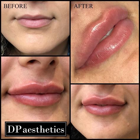 Lip Augmentation 05ml Filler Top Up 1ml In Total Over 2 Sittings