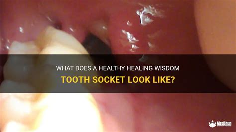 What Does A Healthy Healing Wisdom Tooth Socket Look Like Medshun