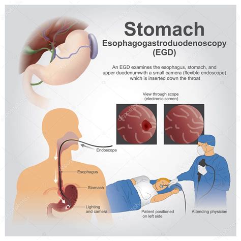 La esofagogastroduodenoscopia también llamada por varios otros nombres es un procedimiento