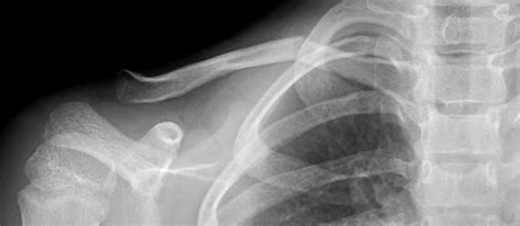 Clinical Practice Guidelines Clavicle Fractures Emergency Department