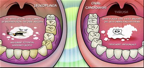 Symptoms Causes And Treatments Of Oral Leukoplakia Sabka Dentist
