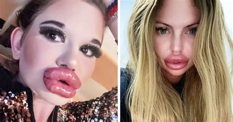 Самые большие губы в мире 5 девушек которые переборщили с филлерами