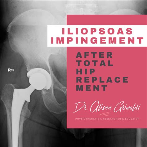 Iliopsoas Impingement After Total Hip Replacement Dr Alison Grimaldi