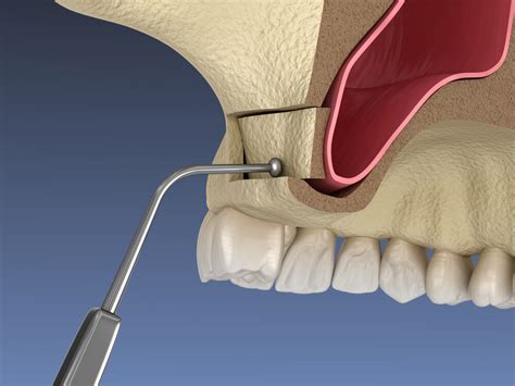 Sinus Lift • Carson Periodontics And Oral And Maxillofacial Surgery