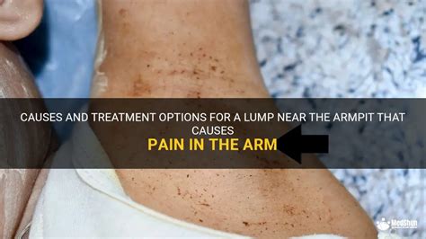 Causes And Treatment Options For A Lump Near The Armpit That Causes Pain In The Arm Medshun