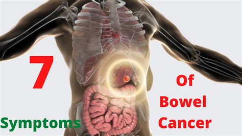 What Are The Signs Of Advanced Bowel Cancer Amudu Colorectal Cancer Signs And Symptoms Of