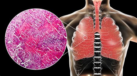 Miliary Tuberculosis Everything You Need To Know