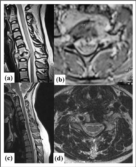 Figure 1 From Cervical Spine Tb Current Concepts In Management