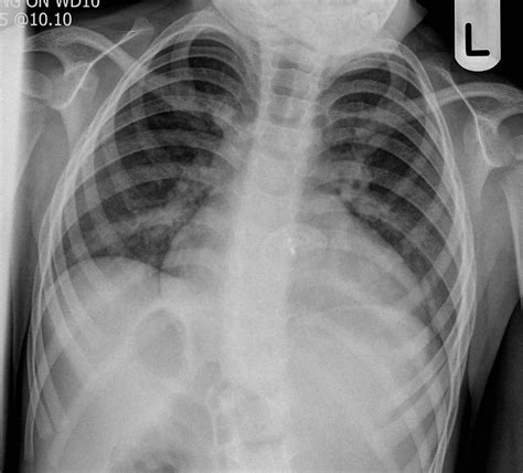 Atrial Septal Closure Closure Device Image