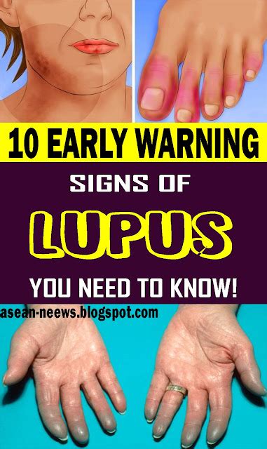 Here Are 10 Early Warning Signs Of Lupus You Need To Know