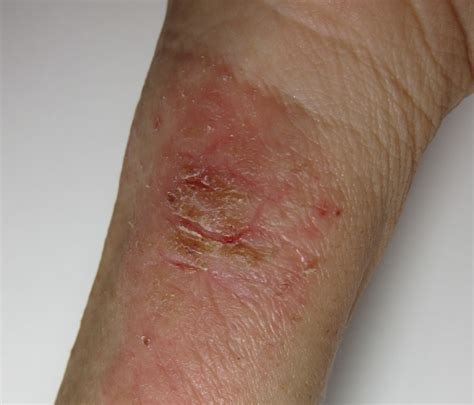 Eczema On The Wrist Yin Yang Dermatology Holistic Healing For Skin
