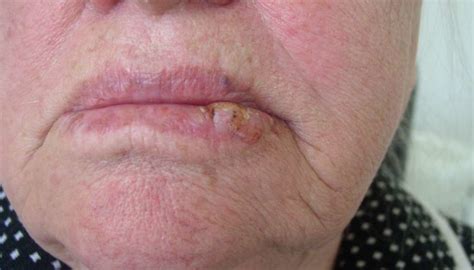 Lip Cancer What It Looks Like And What To Do
