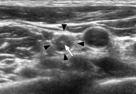 Diagnostic Approach For Evaluation Of Lymph Node Metastasis From Thyroid Cancer Using Ultrasound