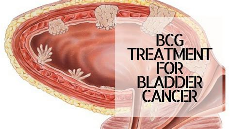 Bcg Treatment For Bladder Cancer Youtube