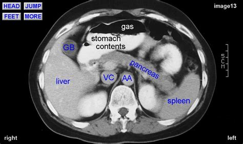Normal Ct Abdominal With Label Yahoo Image Search Results I Love