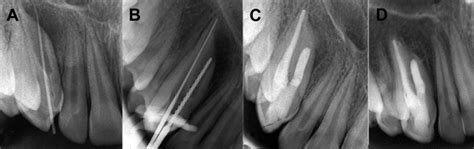 A Periapical Radiograph Showing A Gutta Percha Point Tracing The Sinus