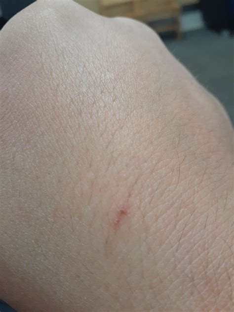 Is This A Bat Bite