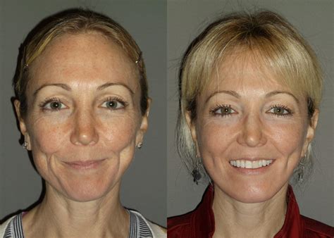 Facelift Disasters Why They Happen And How To Avoid One Larry Rondeau