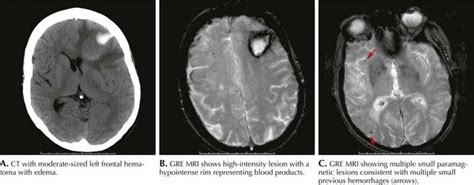 Intracerebral Hemorrhage Neupsy Key