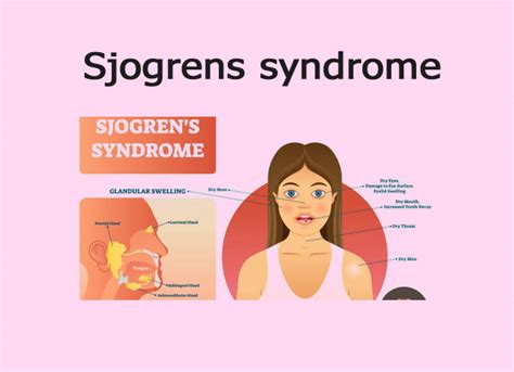 Sjogrens Syndrome Focus Dentistry