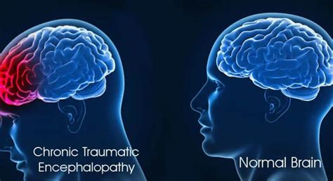 What Is Chronic Traumatic Encephalopathy Causes And Treatment
