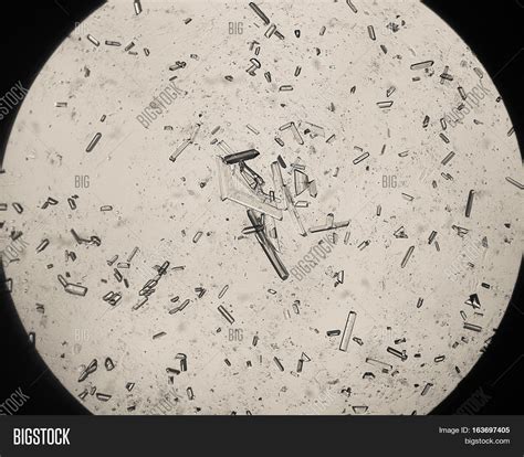 Calcium oxalate, amorphous phosphates and triple phosphate crystals are found in healthy urine. Triple Phosphate Crystals Human Image & Photo | Bigstock