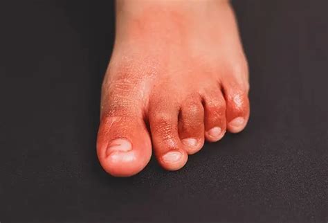 Why Are My Toes Red 8 Causes 31 Symptoms Treatment