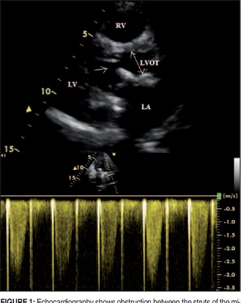 Figure 1 From Left Ventricular Outflow Obstruction By The Strut Of The